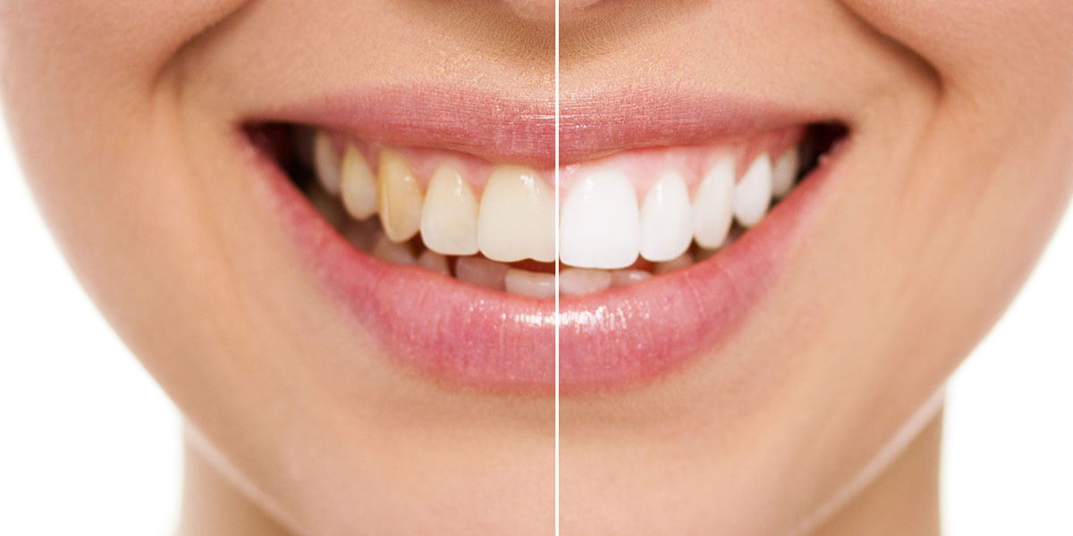 Before and After Image of Whitened Teeth